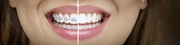 Discover Invisalign consultation in Baulkham Hills: Transform Your Smi
