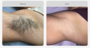 SHR Hair Removal Treatment | Waxing Queen Salon